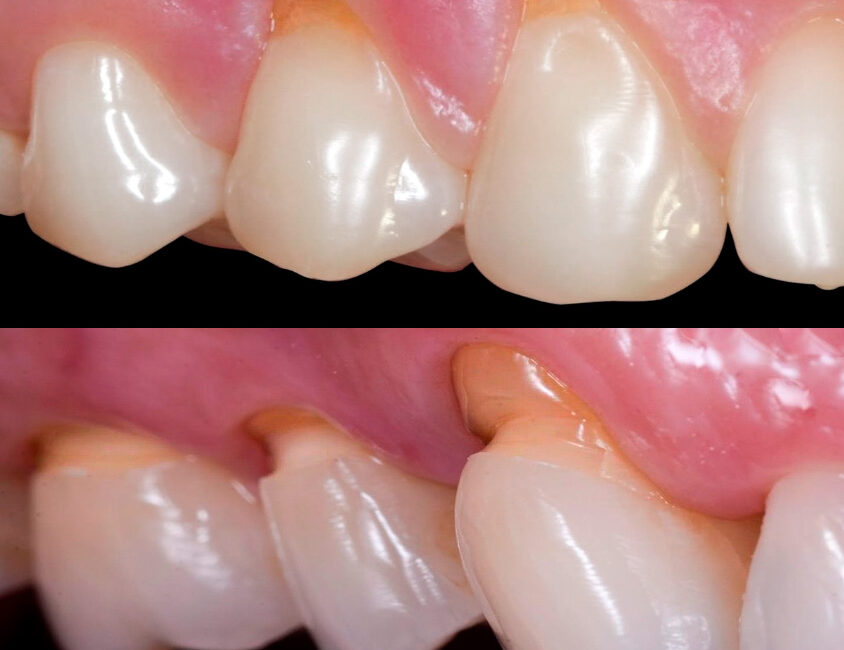 Foto macro de abfração e retração gengival sendo analisada por especialista em Botucatu, Dr. Murilo Manoel.