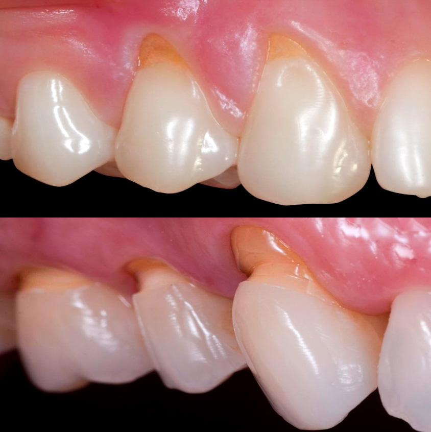 Retração Gengival ou Raiz Exposta: Por que o problema pode não ser a sua escovação?